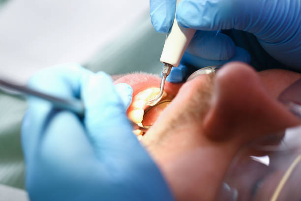 Best Emergency Tooth Extraction in Oak Hill, FL